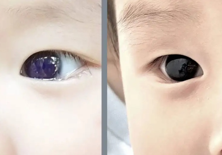 Bebé cambia color de ojos tras tratamiento contra el Covid bebe-cambia-color-de-ojos-tras-tratamiento-contra-el-covid-105619-105718.jpg