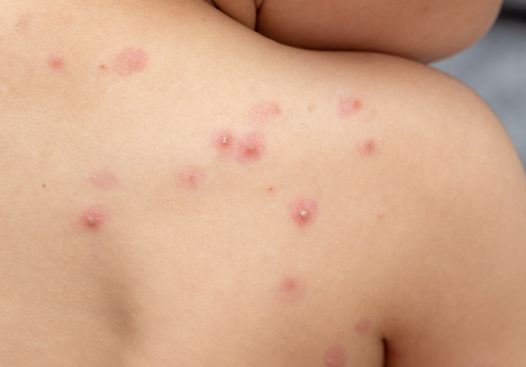 El 90% de contagios de viruela del mono en el paí­s se concentran en la capital según expertos el-90-de-contagios-de-viruela-del-mono-en-el-pais-se-concentran-en-la-capital-segun-expertos-190049-190120.png