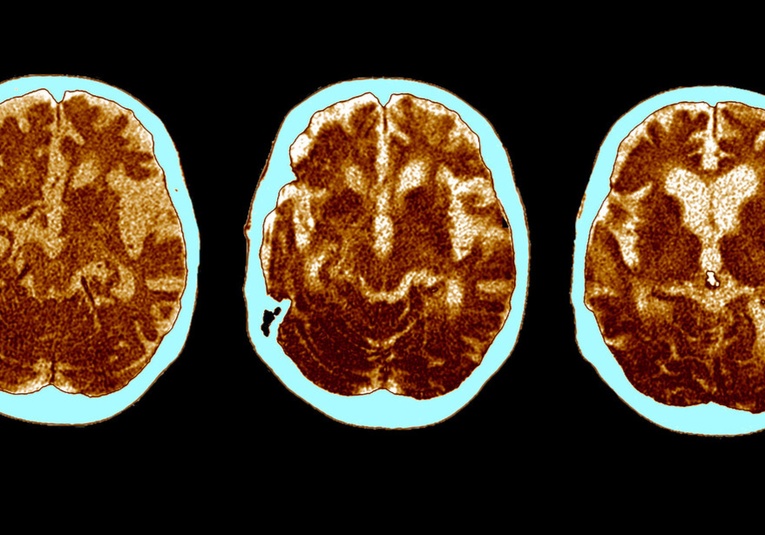 El cerebro de los supervivientes de una forma grave de covid-19 envejece 20 años, dice un nuevo estudio el-cerebro-de-los-supervivientes-de-una-forma-grave-de-covid-19-envejece-20-anos-dice-un-nuevo-estudio-192533-192537.jpg