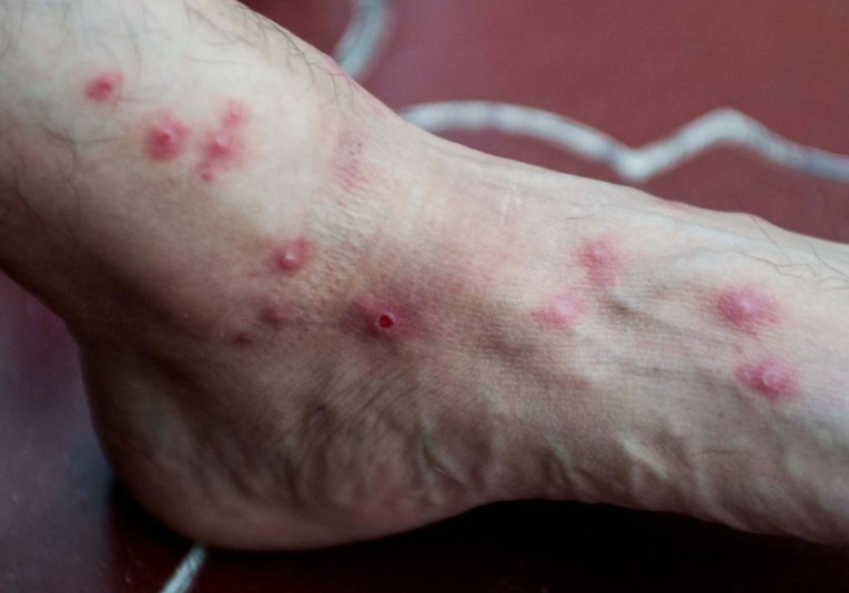 Las autoridades de salud reportan 15 nuevo casos de viruela del mono en el paí­s las-autoridades-de-salud-reportan-15-nuevo-casos-de-viruela-del-mono-en-el-pais-183802-183921.jpg