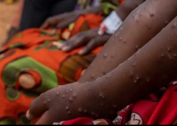 Alemania dona 100 millones de vacunas contra el mpox