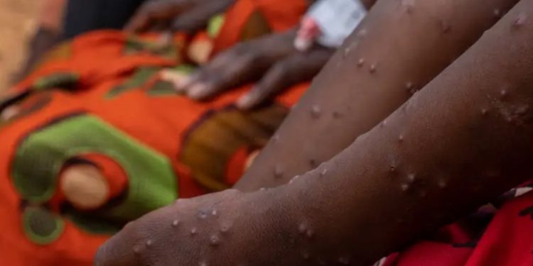 Alemania dona 100 millones de vacunas contra el mpox