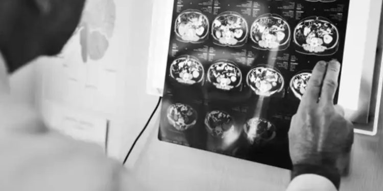 Alerta de salud por padecimiento neurológico