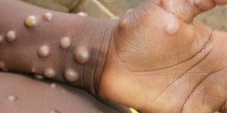 írea de Salud Central no cuentan con protocolos para atender casos de la viruela del mono