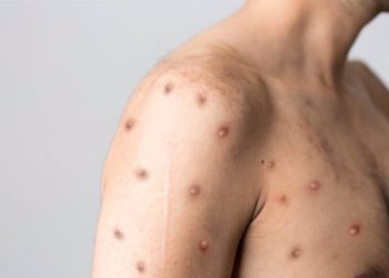 Autoridades de Salud confirman dos nuevos casos de viruela del mono en el paí­s