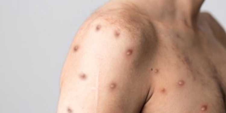 Autoridades de Salud confirman dos nuevos casos de viruela del mono en el país