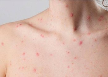 Autoridades de Salud confirman el sexto caso positivo de la viruela del mono en el paí­s