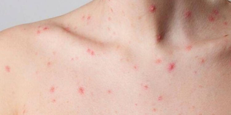 Autoridades de Salud confirman el sexto caso positivo de la viruela del mono en el país