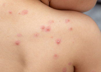 Autoridades de Salud confirman incremento a 32 casos de viruela del mono en el paí­s