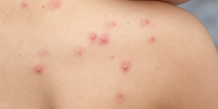 Autoridades de Salud confirman incremento a 32 casos de viruela del mono en el paí­s