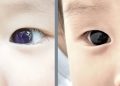 Bebé cambia color de ojos tras tratamiento contra el Covid