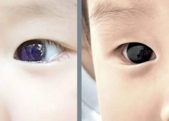 Bebé cambia color de ojos tras tratamiento contra el Covid