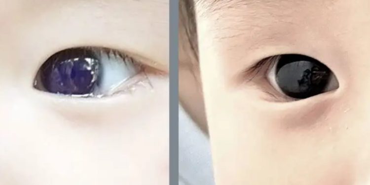 Bebé cambia color de ojos tras tratamiento contra el Covid