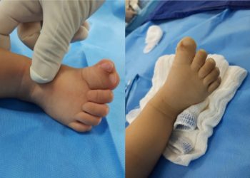 Bebé Con Malformación En Sus Deditos Es Operado Gratuitamente.