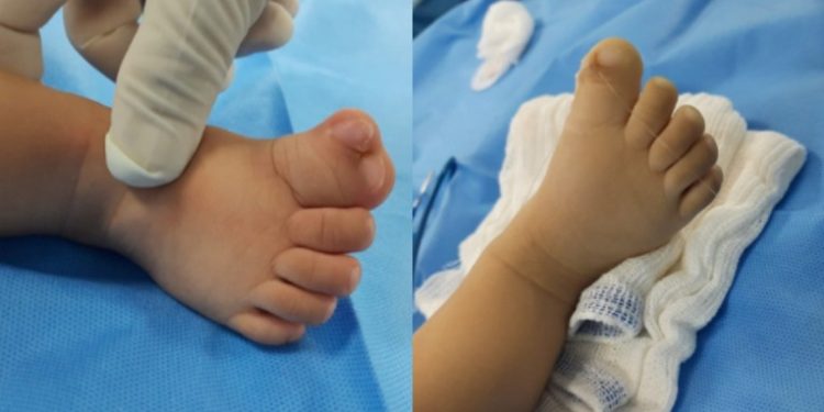 Bebé Con Malformación En Sus Deditos Es Operado Gratuitamente.