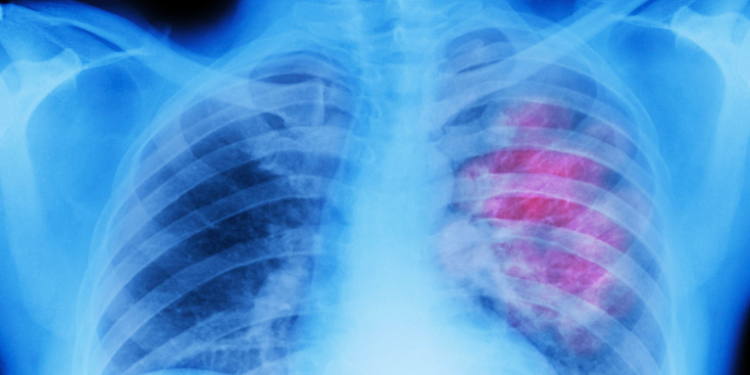 Casi la mitad de las muertes por cáncer se atribuyen a factores de riesgo evitables