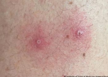 Casos de viruela del mono aumentan un 77 por ciento en una semana