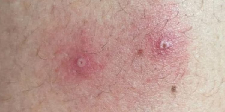 Casos de viruela del mono aumentan un 77 por ciento en una semana