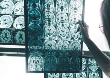 Cientí­ficos desarrollan un enfoque prometedor para una posible vacuna y tratamiento contra el alzhéimer