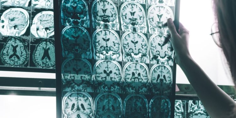 Cientí­ficos desarrollan un enfoque prometedor para una posible vacuna y tratamiento contra el alzhéimer