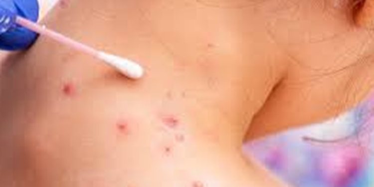 Cinco casos de la viruela del mono han sido detectados y atendidos en el hospital Roosevelt