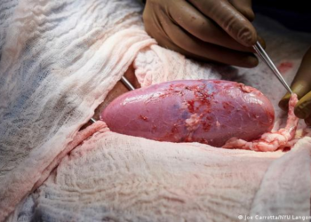 Cirujanos estadounidenses consiguen trasplantar a un paciente un corazón de cerdo