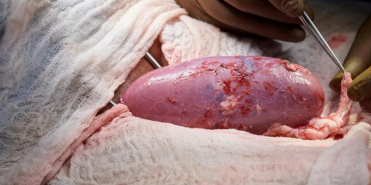 Cirujanos estadounidenses consiguen trasplantar a un paciente un corazón de cerdo