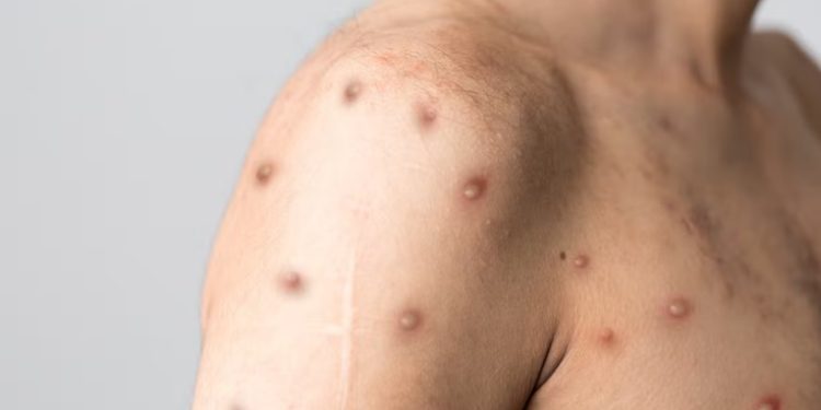 Confirman el onceavo caso de viruela del mono en el país