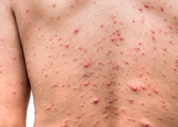 Confirman el primer caso de la viruela del mono en Rusia en un paciente que regresó de Europa