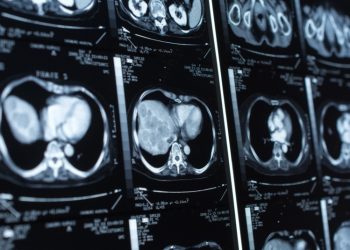 Crean en Irán una prueba para detectar infartos con solo una gota de sangre del dedo