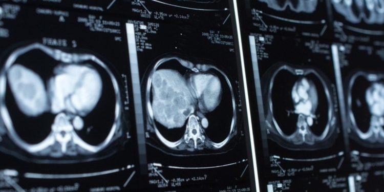 Crean en Irán una prueba para detectar infartos con solo una gota de sangre del dedo