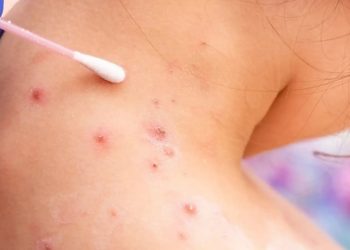 Detectan nuevo caso de viruela del mono en el paí­s