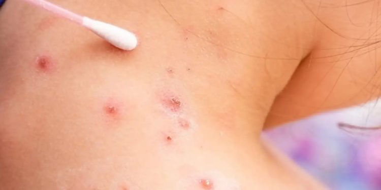 Detectan nuevo caso de viruela del mono en el paí­s