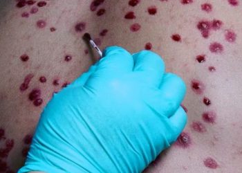 EE.UU. declara emergencia sanitaria nacional por el brote de viruela del mono