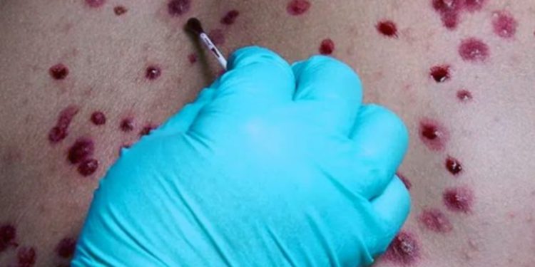 EE.UU. declara emergencia sanitaria nacional por el brote de viruela del mono