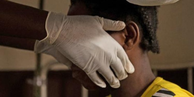 EE.UU., Suecia y Gran Canaria detectan primeros casos de viruela del mono