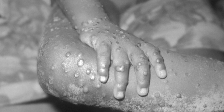 EE.UU. y Europa registran casos de la viruela del mono: Â¿Qué se sabe de la enfermedad? Â¿Cuán peligrosa es? Â¿Hay tratamiento?