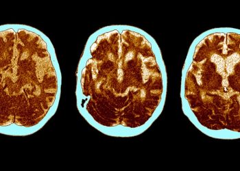 El cerebro de los supervivientes de una forma grave de covid-19 envejece 20 años, dice un nuevo estudio