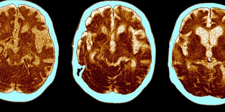 El cerebro de los supervivientes de una forma grave de covid-19 envejece 20 años, dice un nuevo estudio