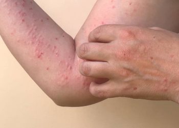 El laboratorio nacional de salud reportó 9 casos más de la Viruela del Mono