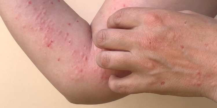 El laboratorio nacional de salud reportó 9 casos más de la Viruela del Mono