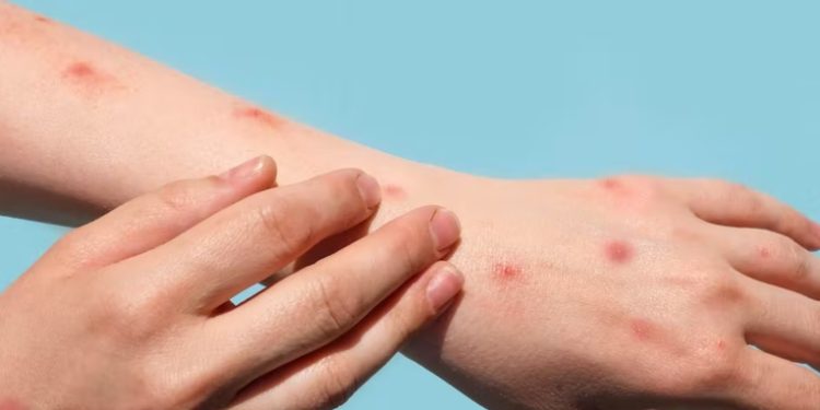 El Ministerio de Salud confirma 22 nuevos casos de viruela del mono en el paí­s