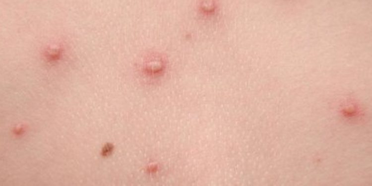 El paí­s alcanza oficialmente los 24 casos positivos de la viruela del mono