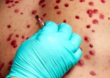 Â¿Es la viruela del mono una enfermedad de transmisión sexual?