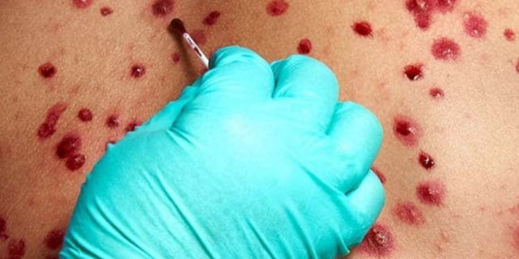 Â¿Es la viruela del mono una enfermedad de transmisión sexual?