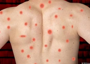 Expertos británicos presentan ensayo de tratamiento Tecovirimat para combatir la Viruela del mono