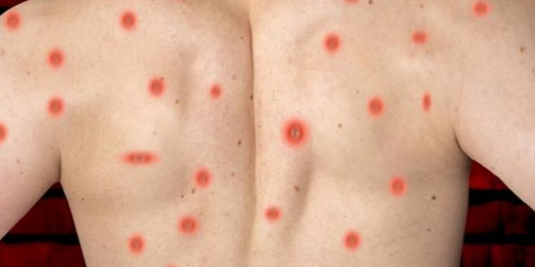 Expertos británicos presentan ensayo de tratamiento Tecovirimat para combatir la Viruela del mono