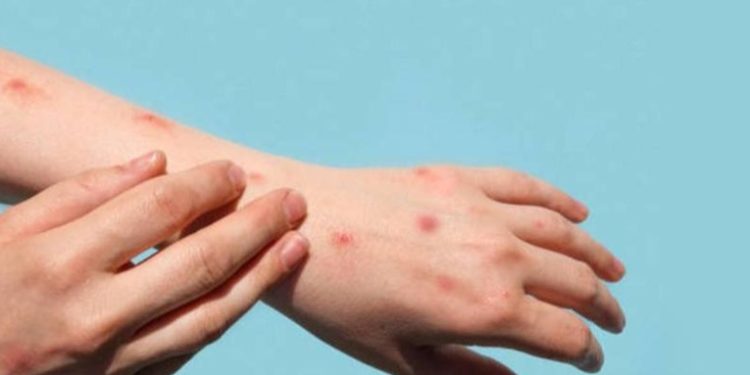 Guatemala es el paí­s de Centroamérica con más casos positivos de la viruela del mono