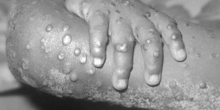 Guatemala se prepara para afrontar un posible brote de la viruela del mono