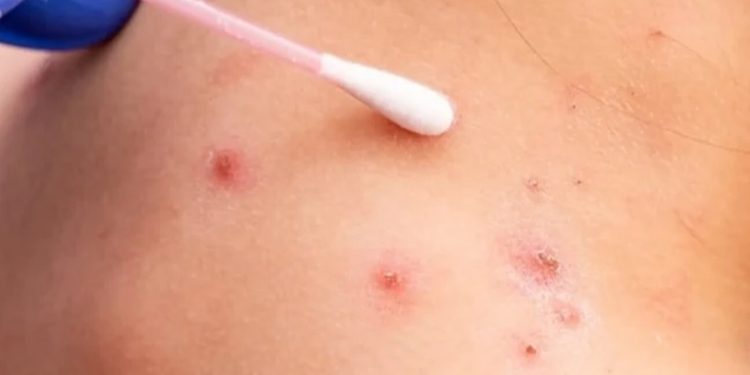 Guatemala y OMS coordinan esfuerzos para evitar la llegada de la viruela del mono al país